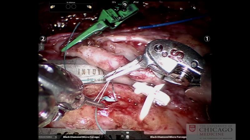 Anastomotic Techniques for Robotic Beating-Heart Totally Endoscopic Coronary Artery Bypass (TECAB)